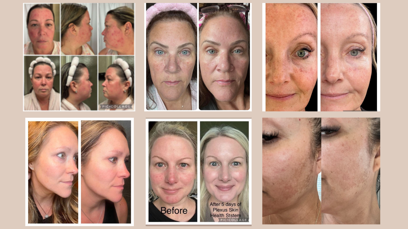 Skin Health System before and after results 1