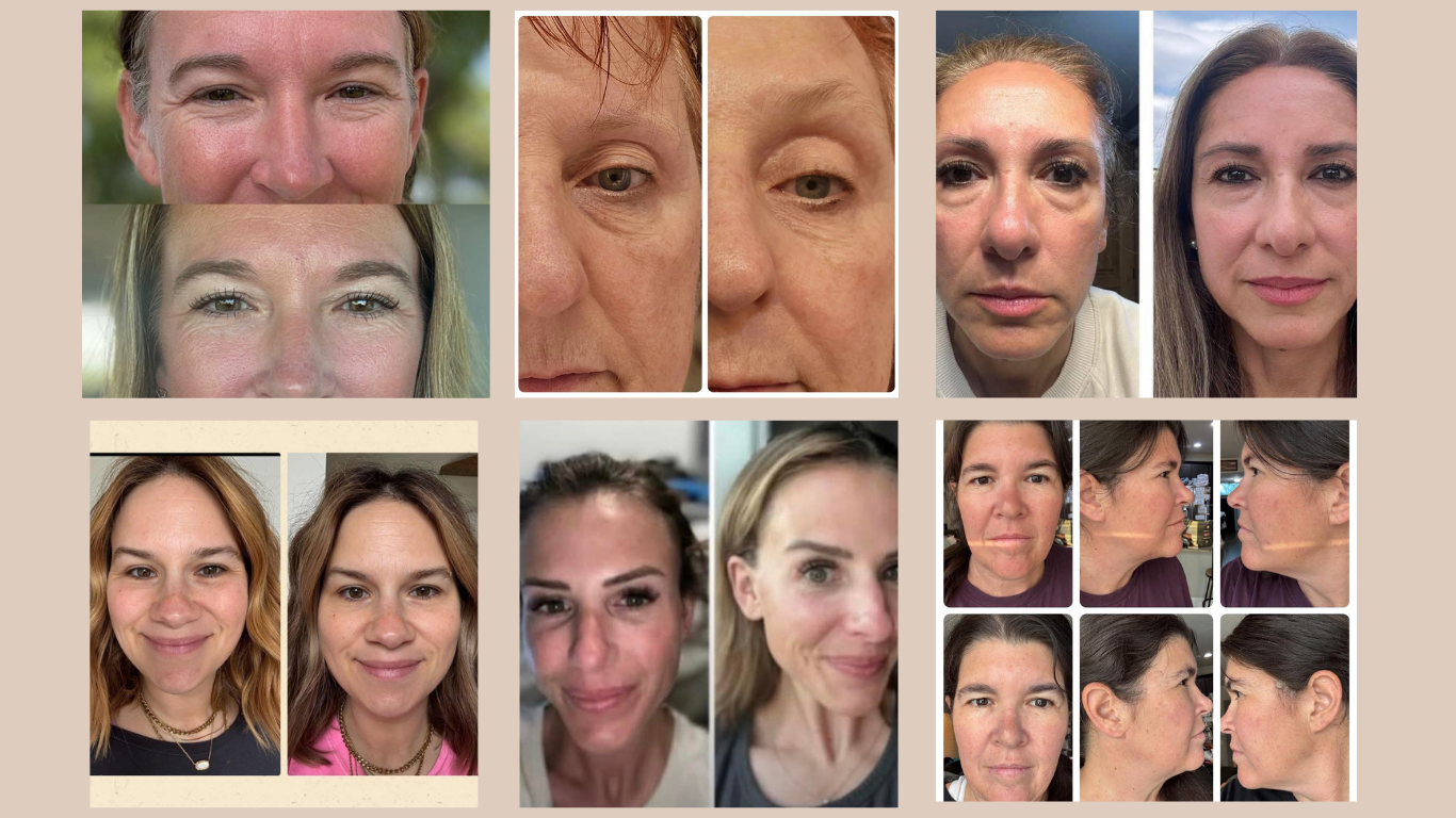 Skin Health System before and after results 2